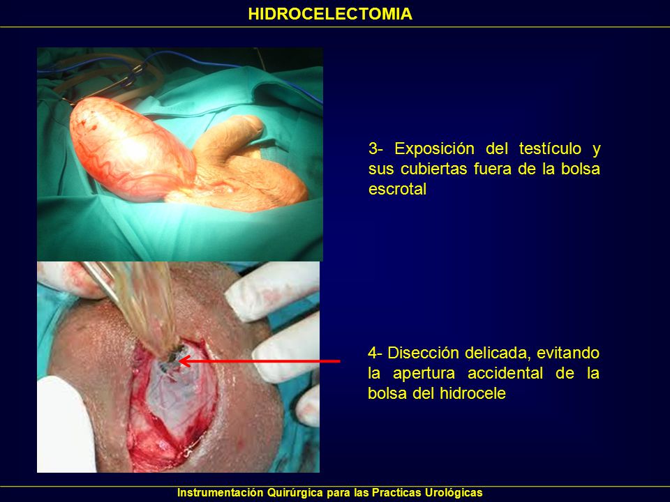 hidrocelectomia tecnica quirurgica